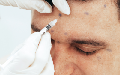 Beneficios del Botox Preventivo: ¿Por Qué Empezar Antes de que Aparezcan las Arrugas?